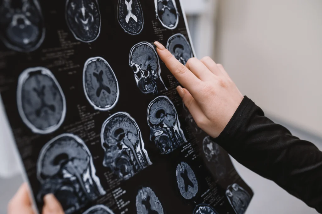 Áttörés: két gyógyszer visszafordíthatja az Alzheimer-kórt